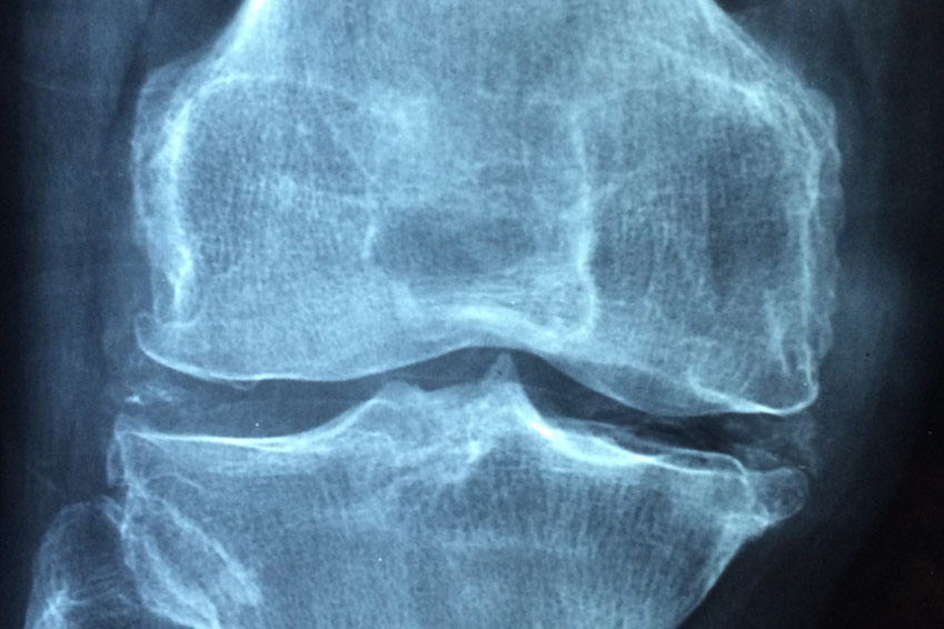 Radiographie du genoux arthrose